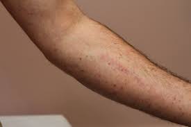 Tăng dưỡng bào hệ thống - Hình ảnh minh họa